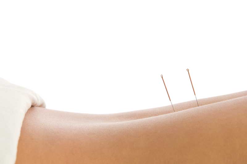Dry Needling what is it & what are the side effects